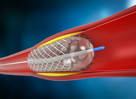 Common Heart Procedures An Overview
