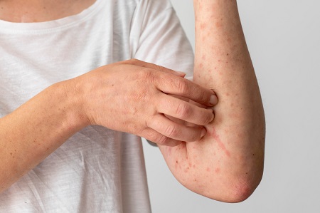 Causes, Symptoms and Treatment of Eczema
