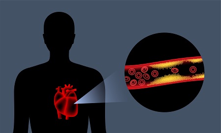 All You Need To Know About Coronary Artery Disease