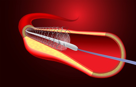 Angioplasty and Stent Placement – How Is It Done?