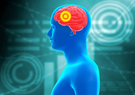 4 Things to Know About Pituitary Tumours