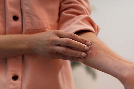 White Patches on the Skin – A Treatable Condition