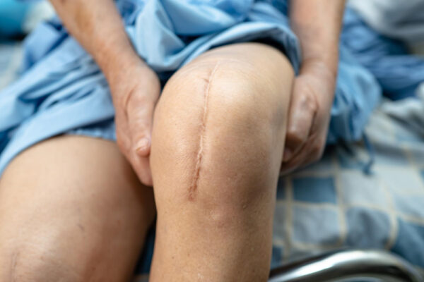 What to Do About Surgical Scars